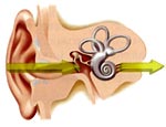 Медтехника :: слуховые аппараты